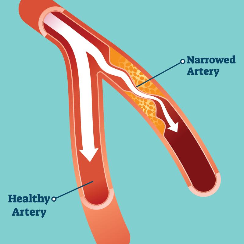 peripheral-artery-vascular-disease